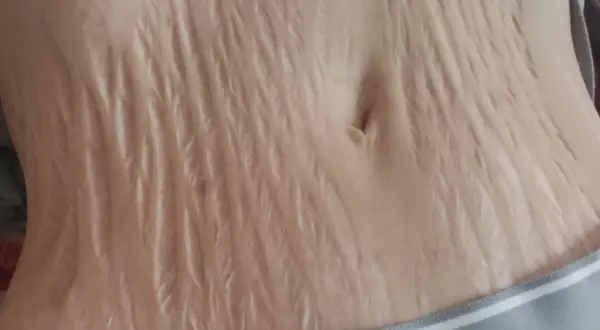 Nahaufnahme des Bauches mit vielen hellen Dehnungsstreifen, die wie ein natürliches Tattoo aussehen.