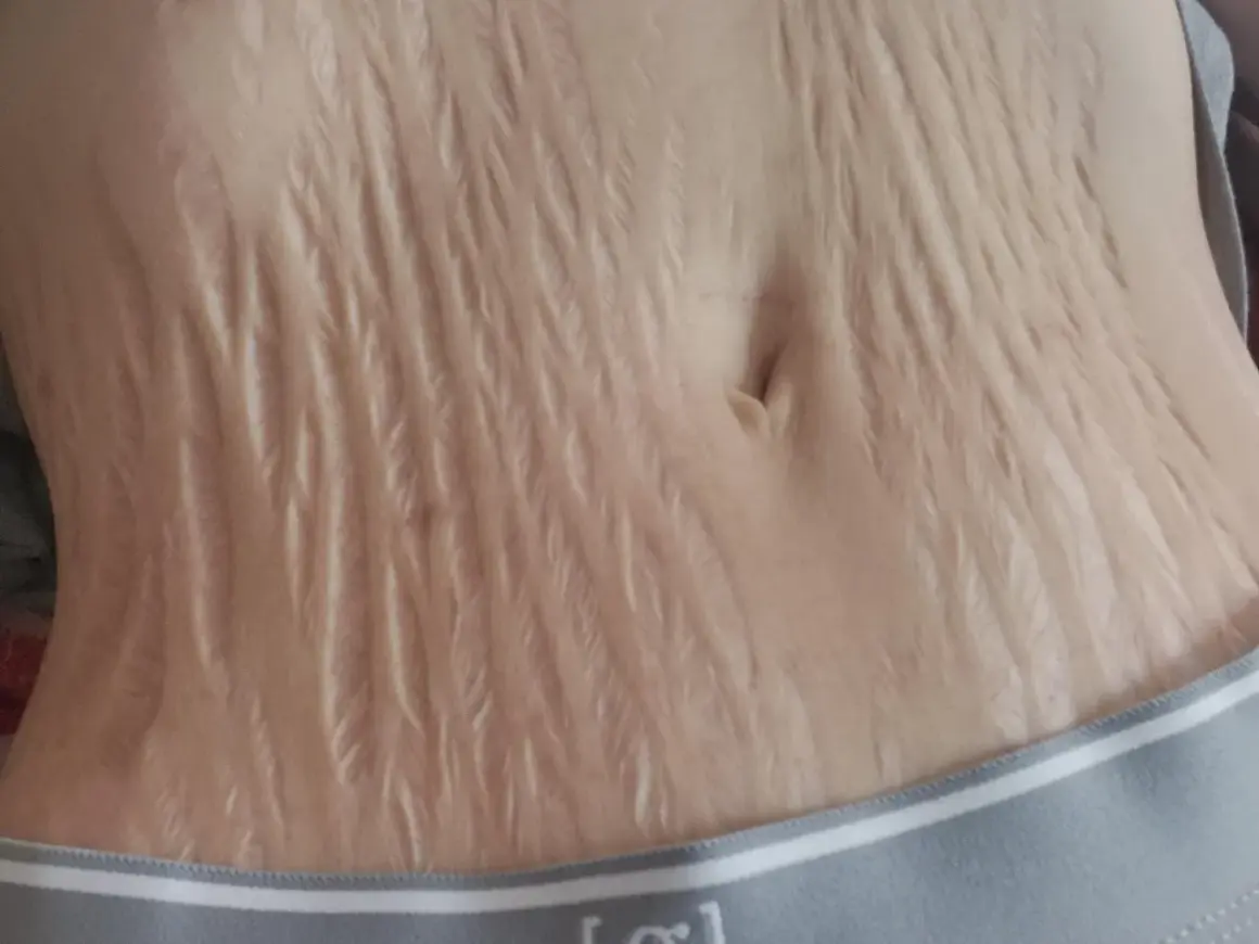 Nahaufnahme des Bauches mit vielen hellen Dehnungsstreifen, die wie ein natürliches Tattoo aussehen.