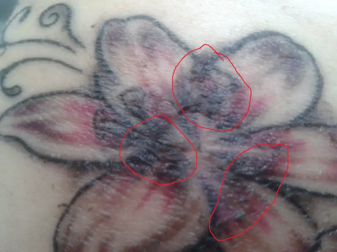 Nahaufnahme eines verheilenden Tattoos einer Blume. Rote Kreise markieren Bereiche mit Krustenbildung, die auf die tattoo kruste hinweisen.